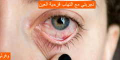 تجربتي مع التهاب قزحية العين